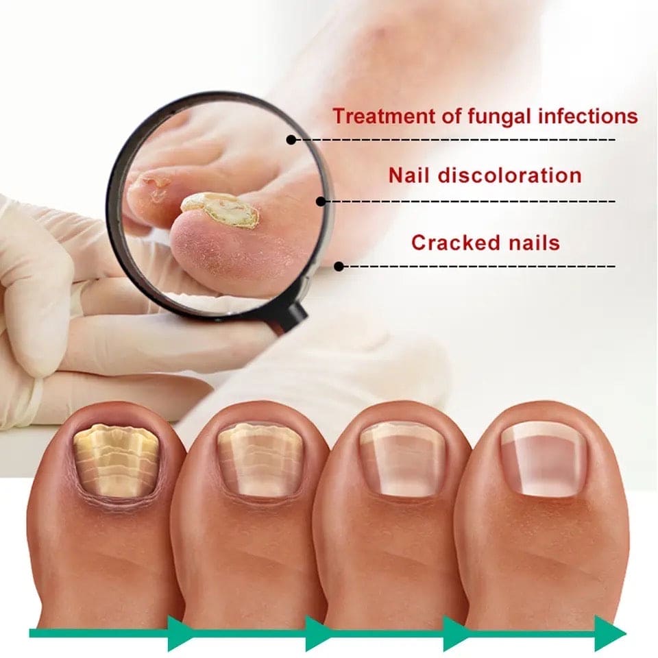 Nail Fungus Solution, Anti Infection Nail Fungus Removal Gel, Ingrown Toenail Treatment Nail Care Oil, Nail Fungus Treatments Serum Nail Fungus Solution, Anti Infection Nail Fungus Removal Gel, Ingrown Toenail Treatment Nail Care Oil, Nail Fungus Treatments Serum
